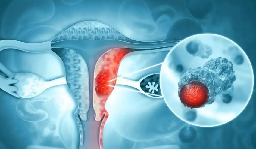 Microplastics Detected in Human Ovaries for the First Time: Alarming Implications for Women’s Health