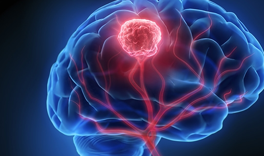Rising Brain Tumour Cases in India: What’s Next for Treatment and Care?